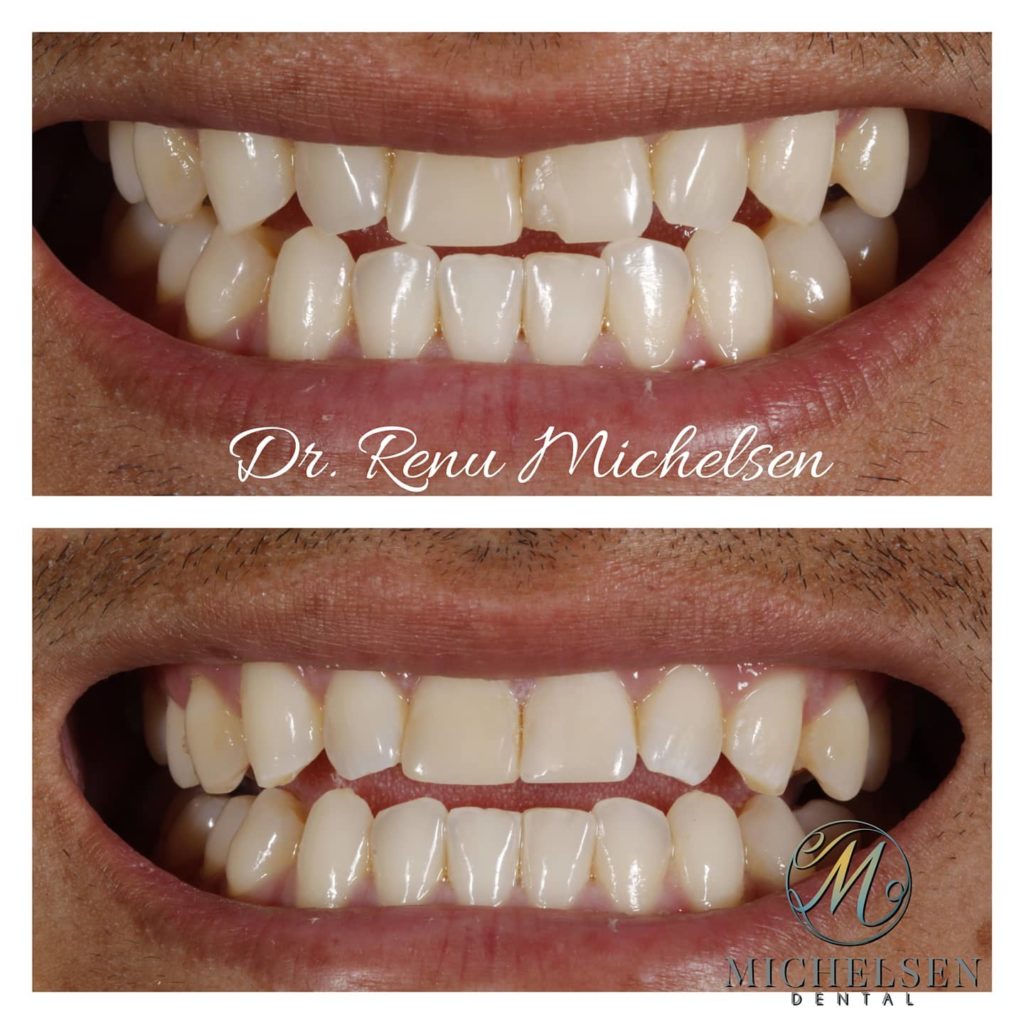 Dental bonding to improve the shape of teeth