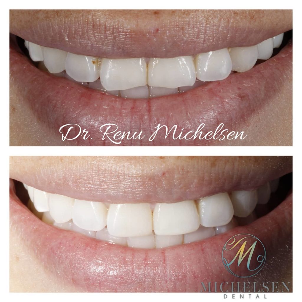 Cosmetic dental bonding for a more balanced smile