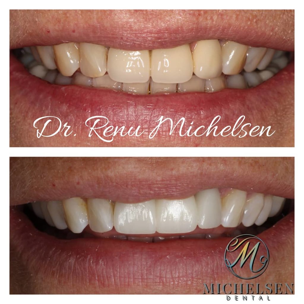 Dental bridge treatment for restoring missing teeth