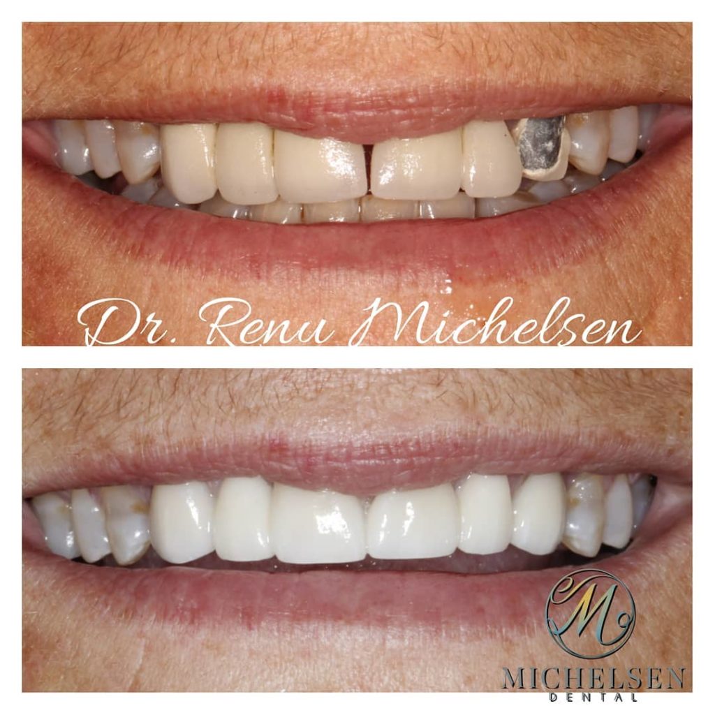 Dental bridge for replacing missing teeth