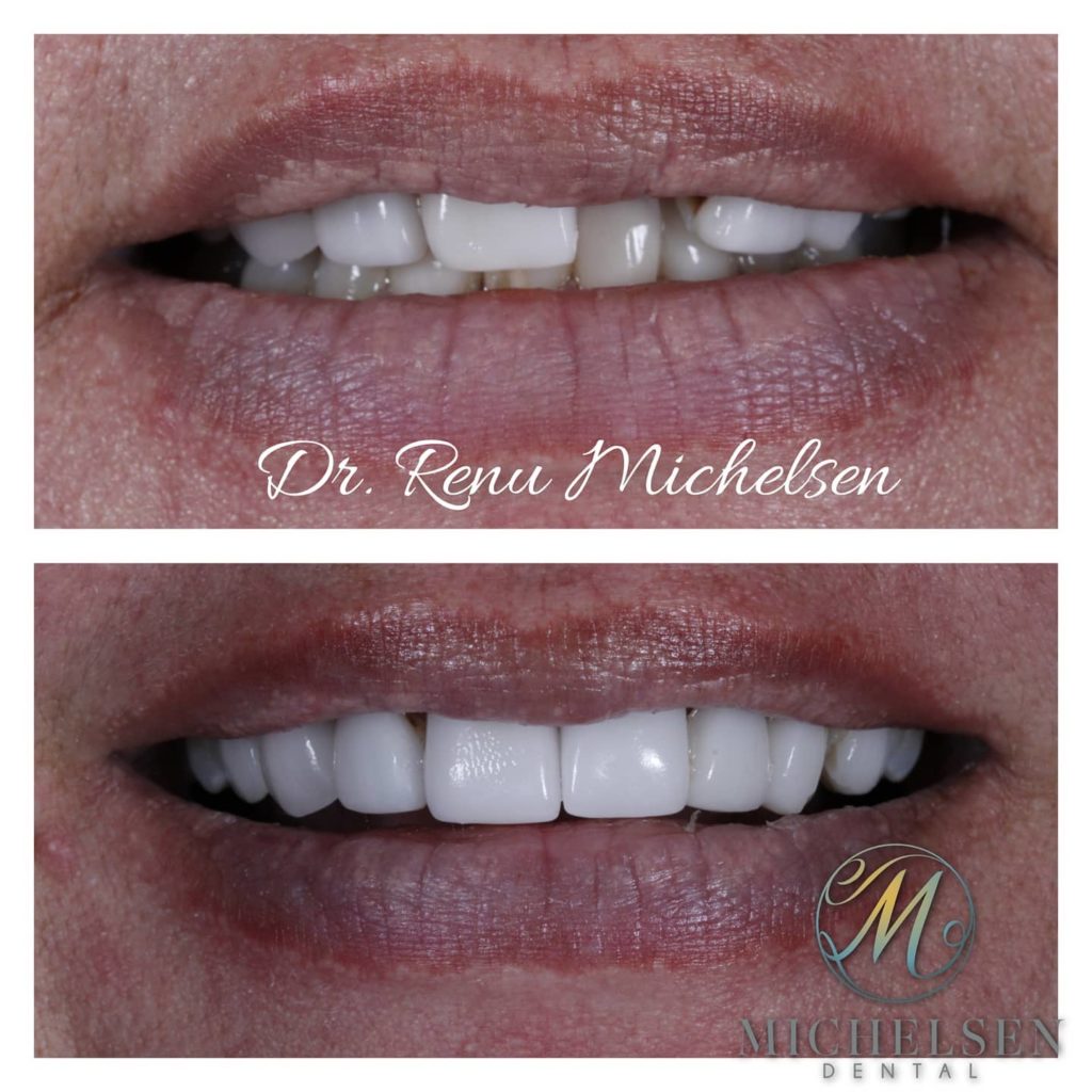 Dental bridge restoration for missing teeth