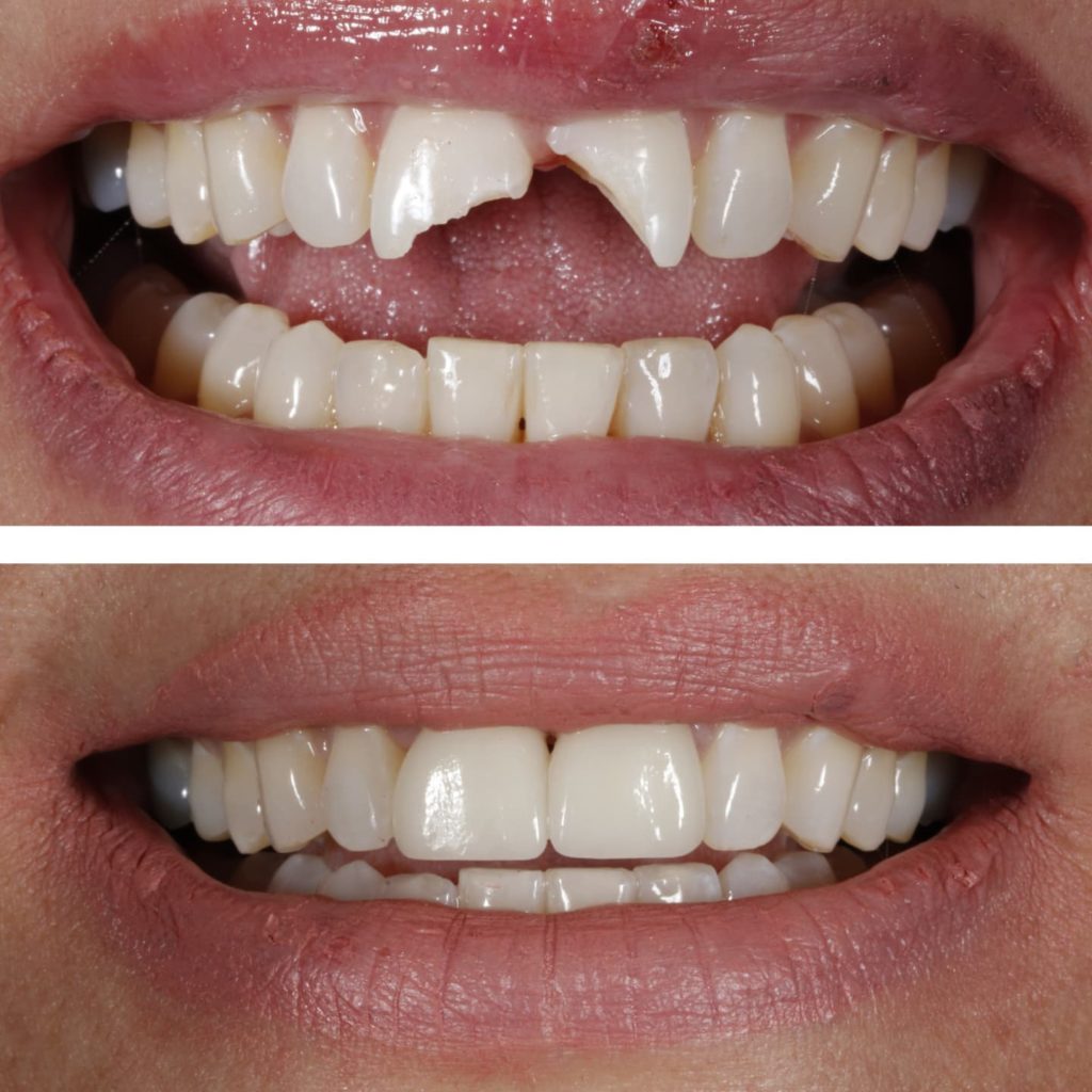 Dental crown treatment for a restored smile