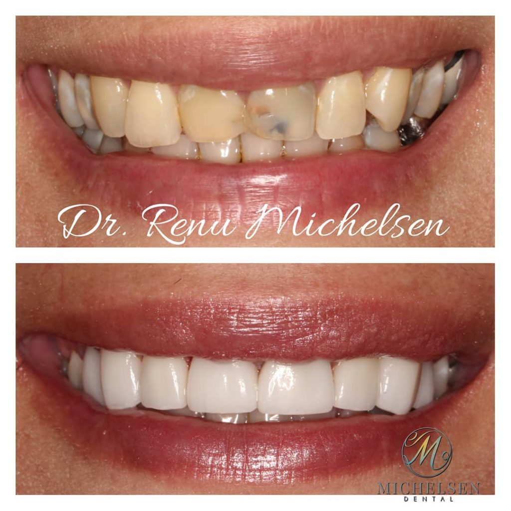 Same-day dental crown treatment