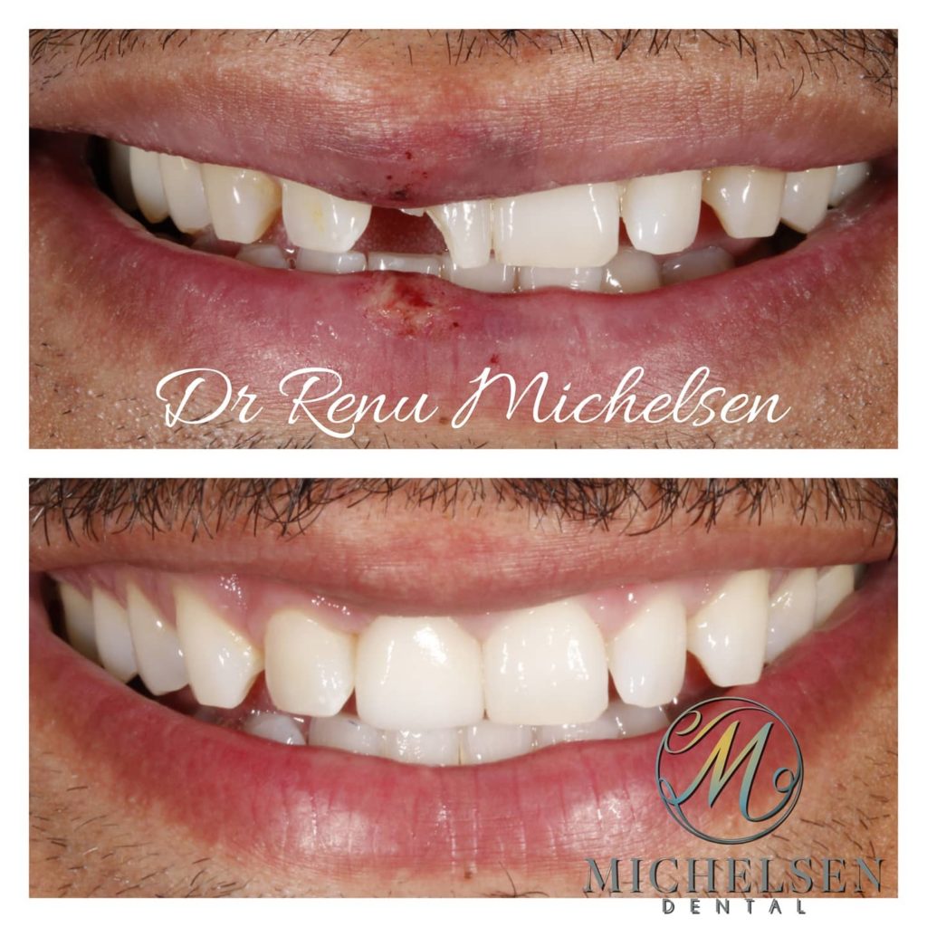 Tooth restoration with a custom dental crown