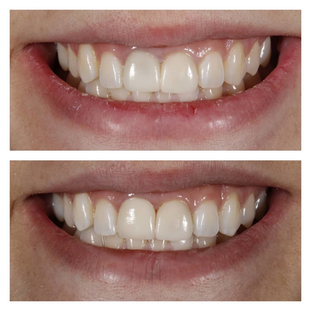 Dental crown restoration for a damaged tooth