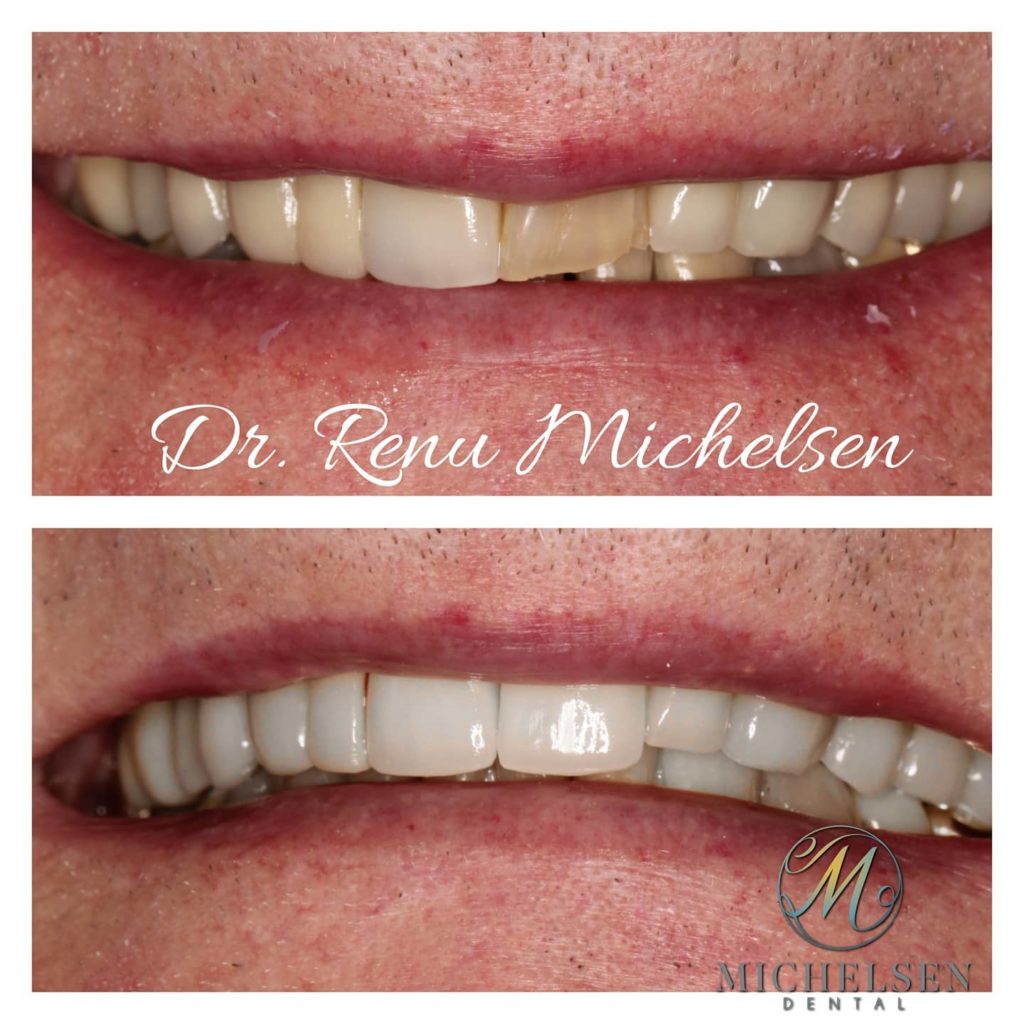 Dental crown treatment for tooth restoration