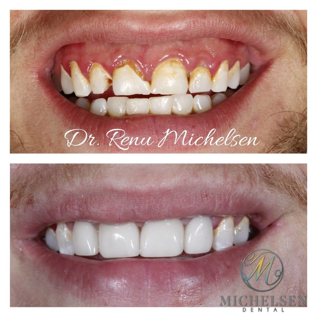 Dental crown restoration for a healthy-looking smile