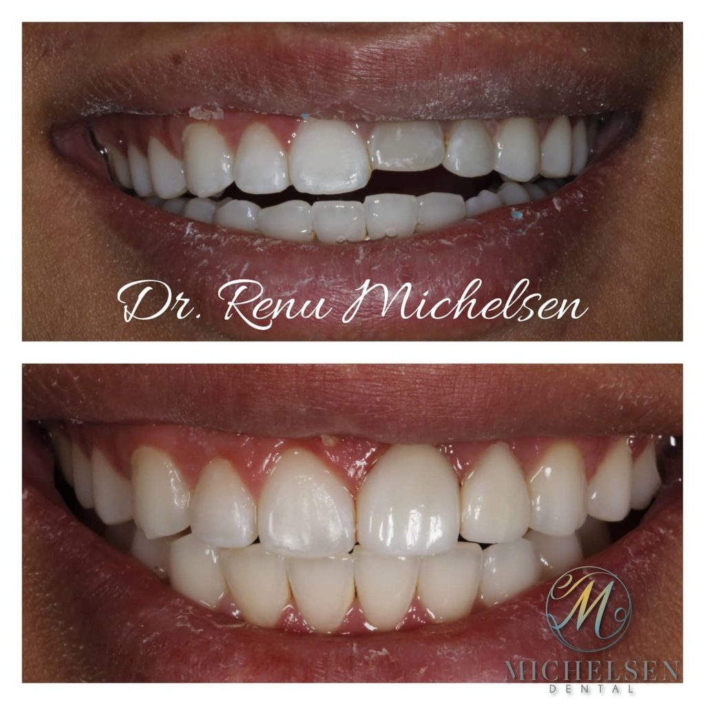 Dental crown restoration for damaged teeth