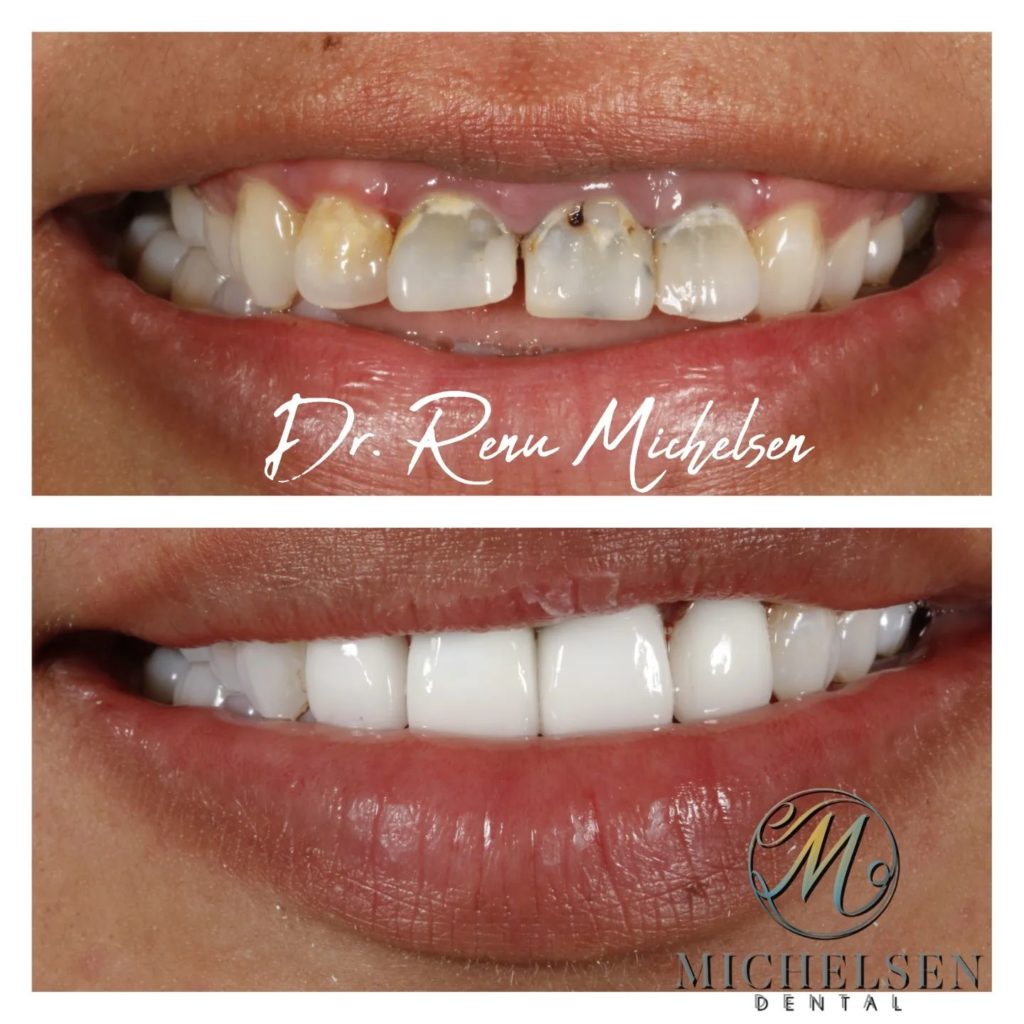Dental crown restoration for damaged teeth