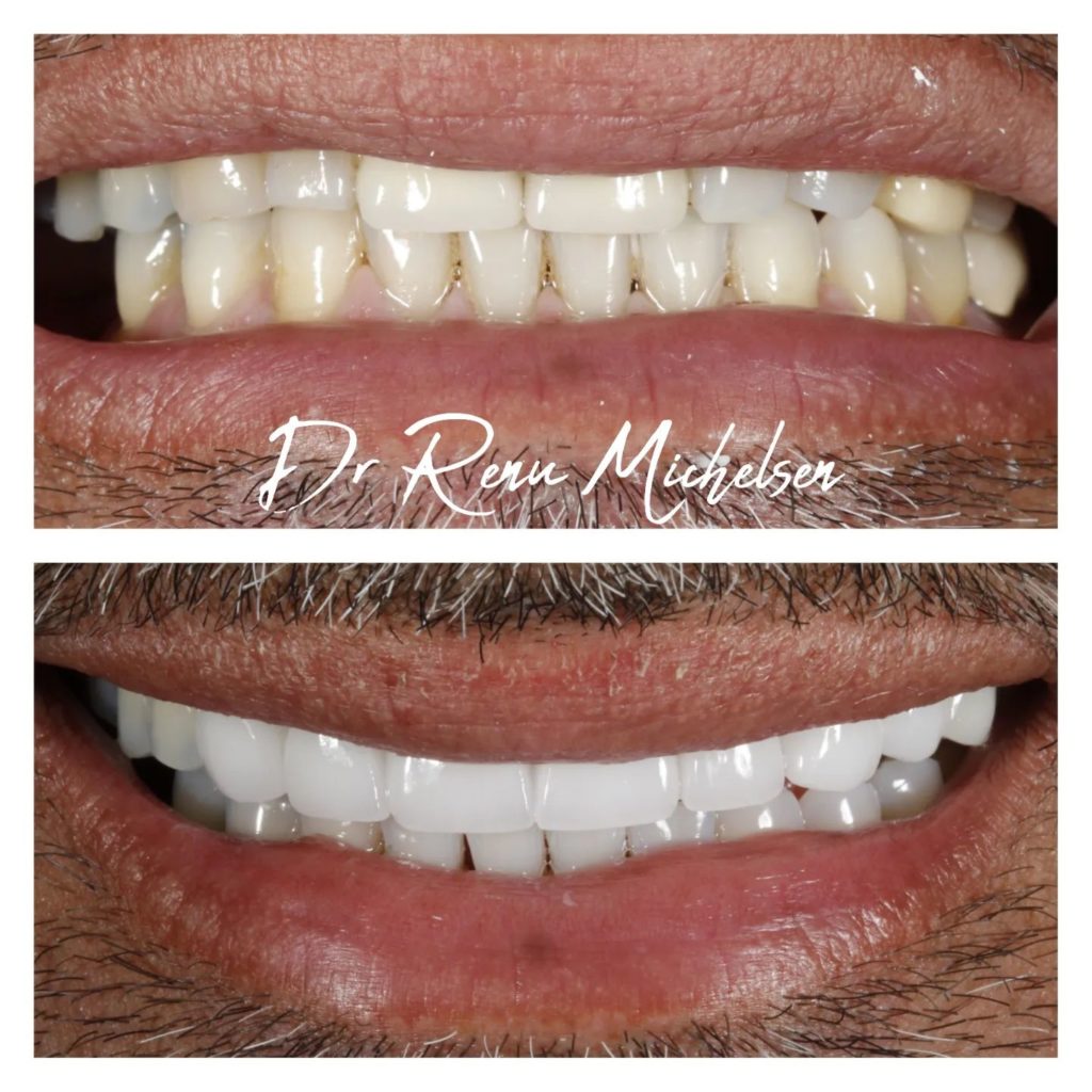 Dental crown treatment for restoring damaged teeth