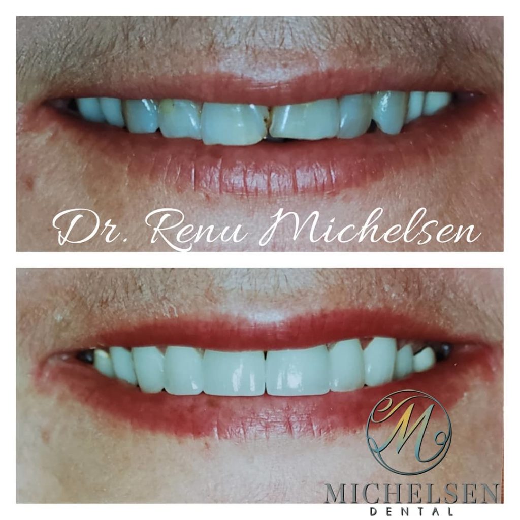 Dental crown restoration for a stronger smile