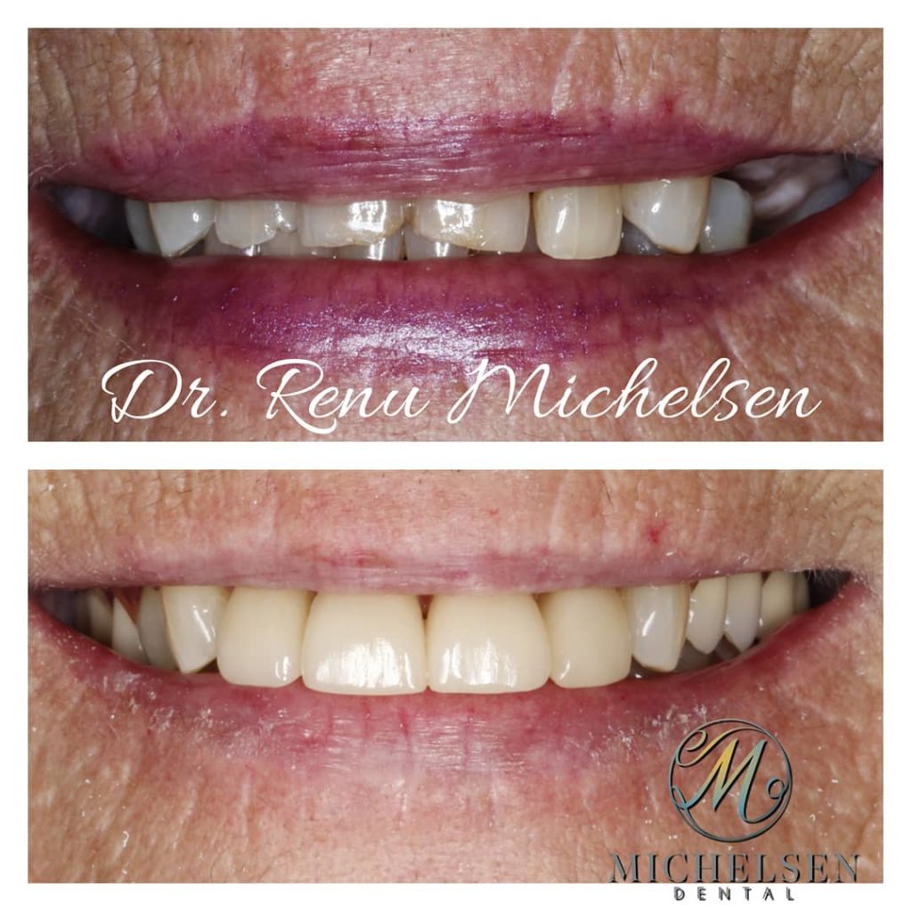 Custom dentures for replacing missing teeth