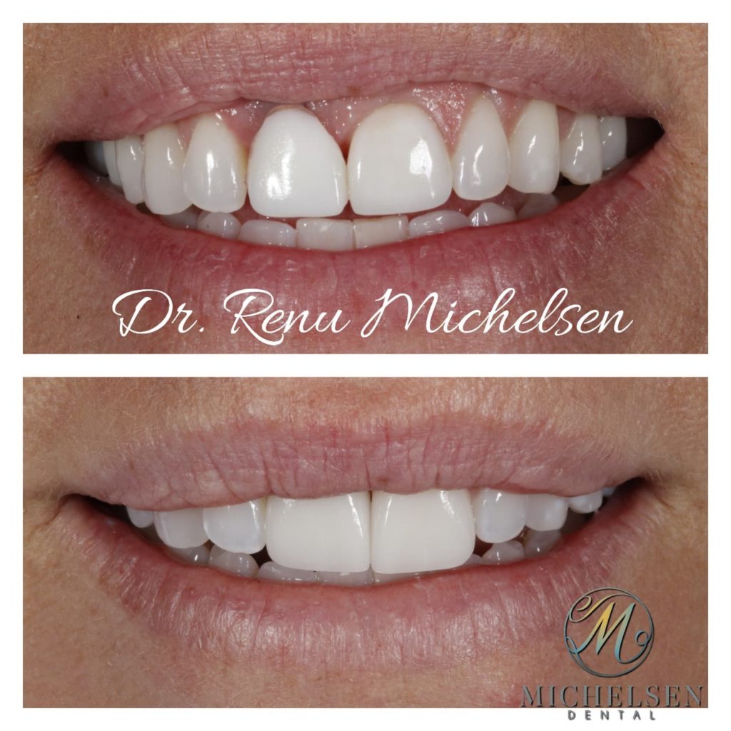 Dental implant treatment for replacing missing teeth
