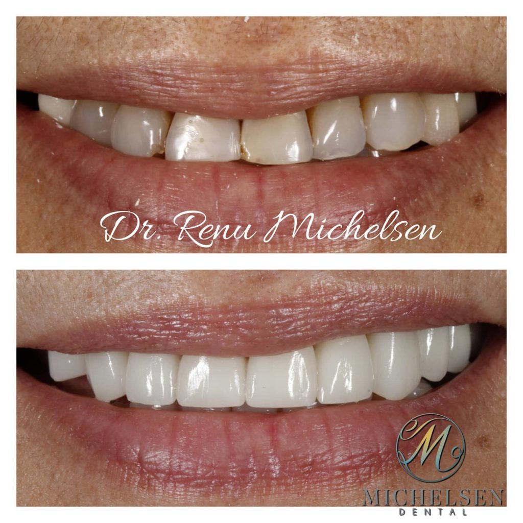 Dental implant treatment for missing teeth