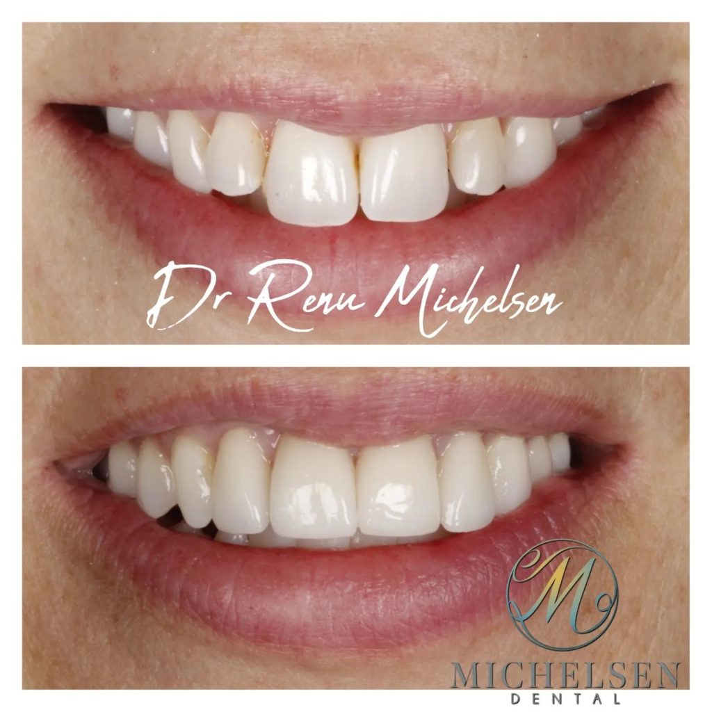 Custom dental veneers for a beautiful smile