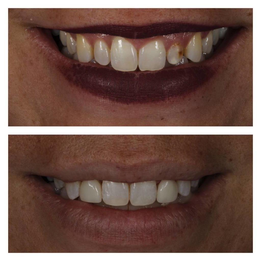 Porcelain veneer treatment for an improved smile