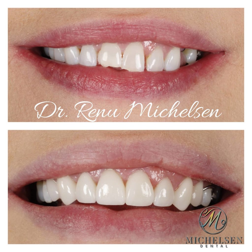 Porcelain veneers for a brighter and more confident smile