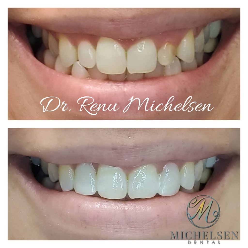 Porcelain veneers for a natural-looking smile