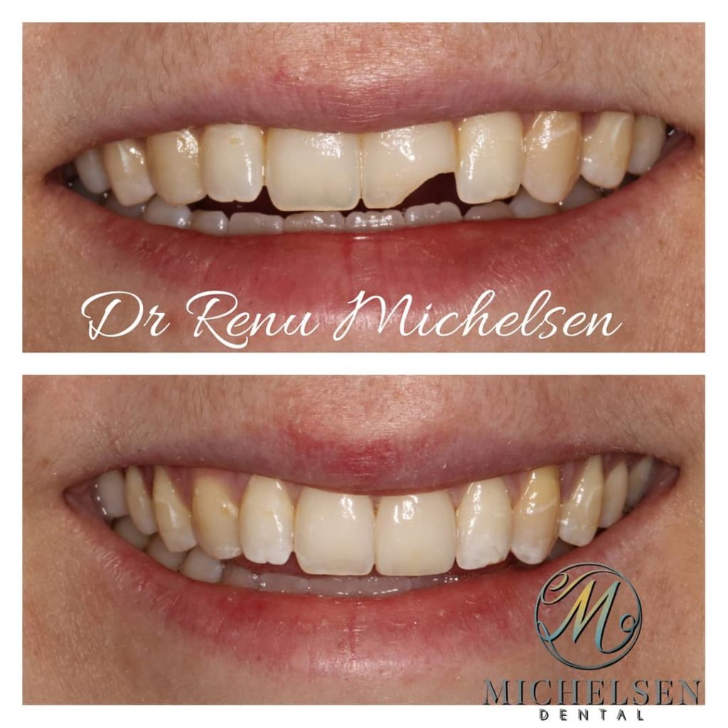 Cosmetic porcelain veneers for a natural-looking smile