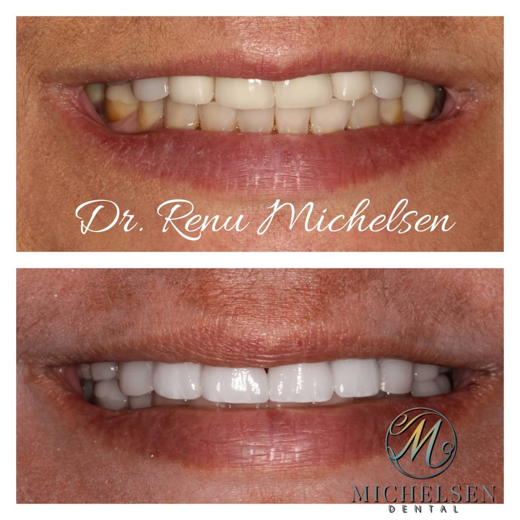 Porcelain veneers for a brighter and natural-looking smile