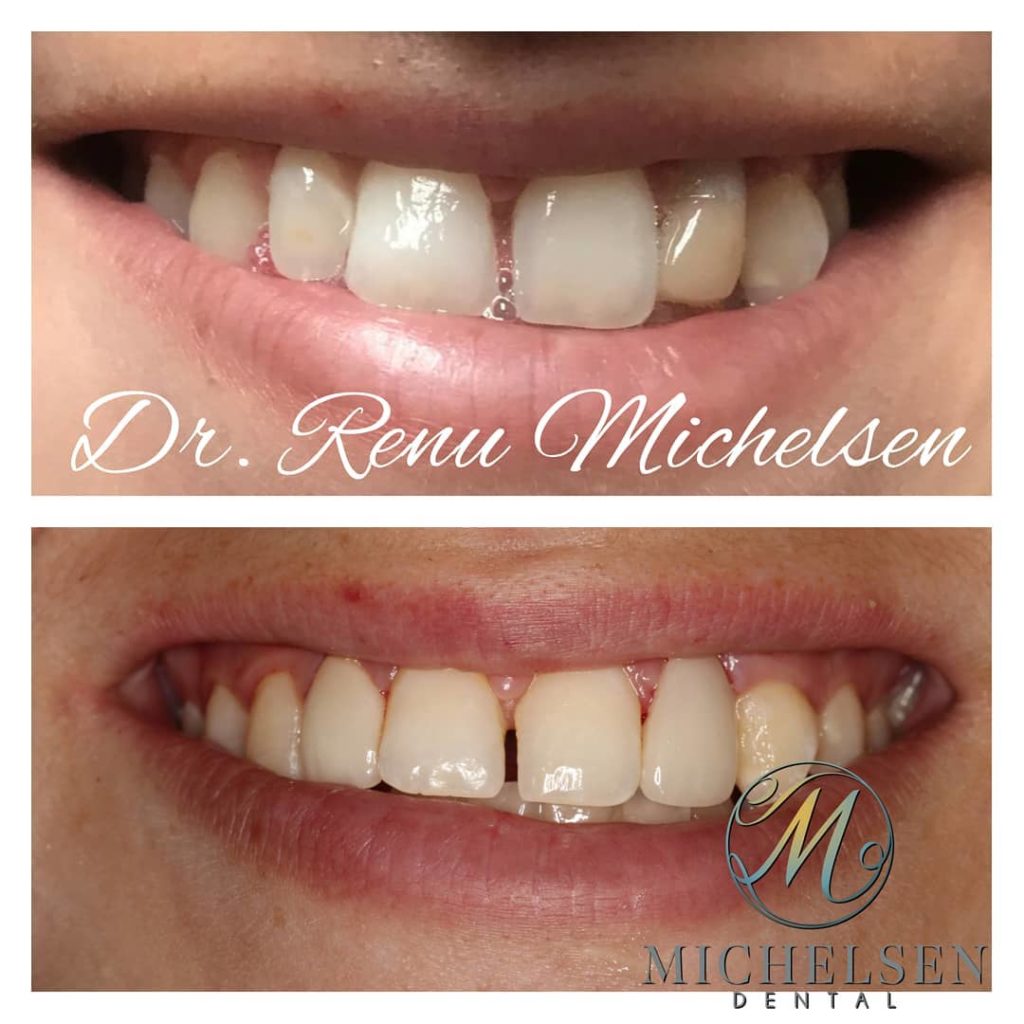 Natural-looking porcelain veneers for smile enhancement