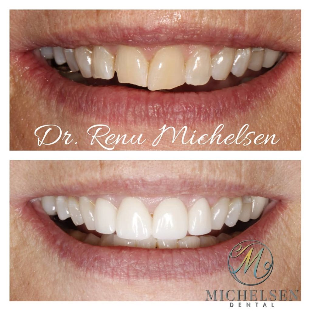 Porcelain veneers for enhancing tooth appearance