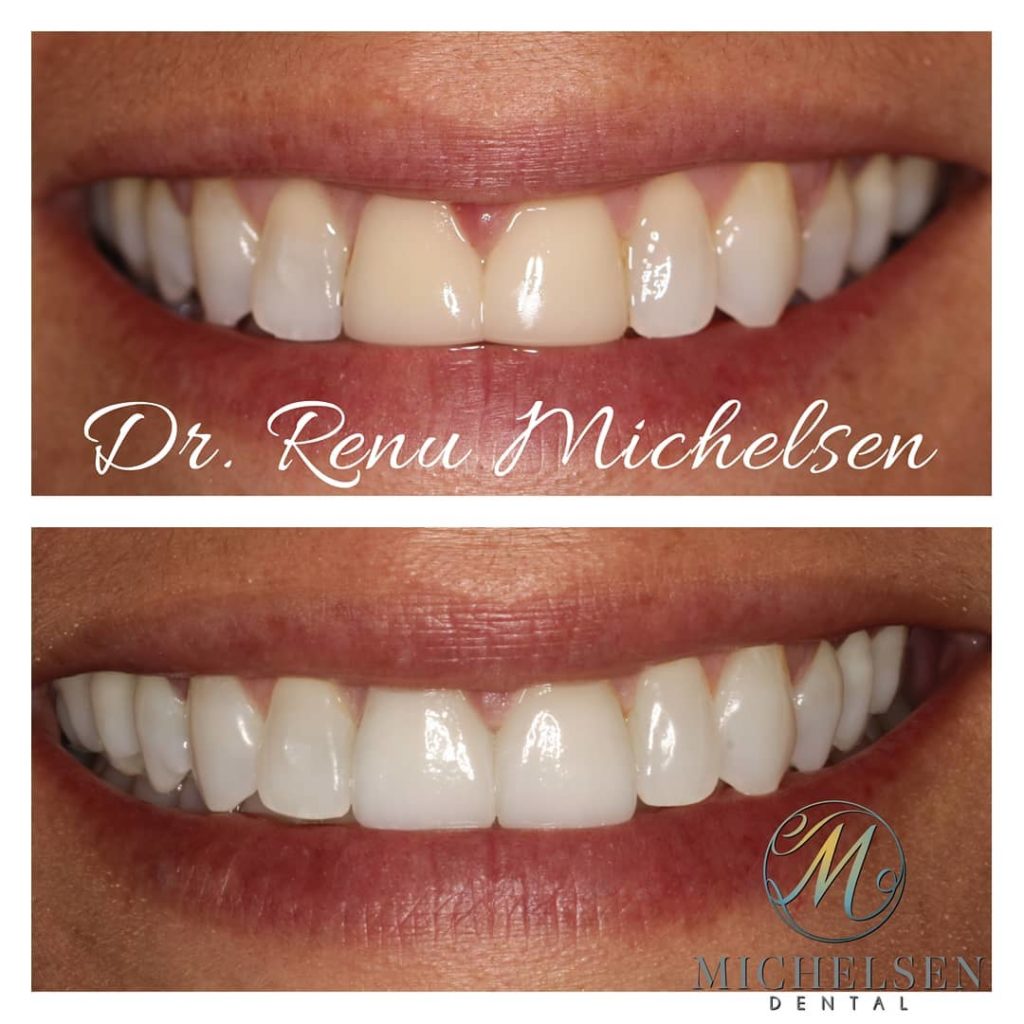 Porcelain veneer treatment for an improved smile