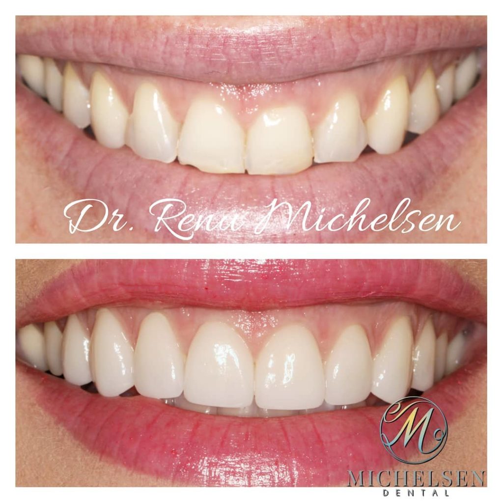 Custom porcelain veneers for an enhanced smile