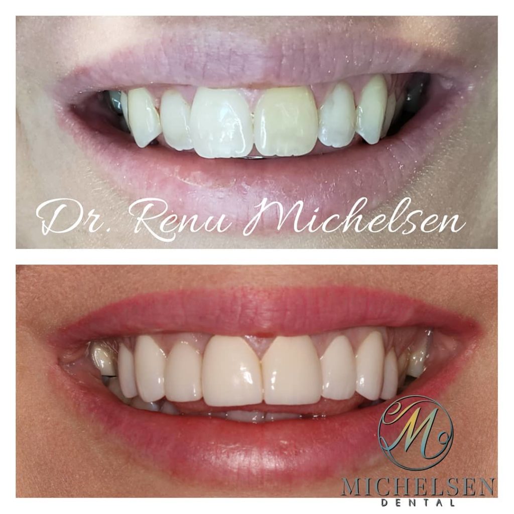 Custom porcelain veneers for an enhanced smile