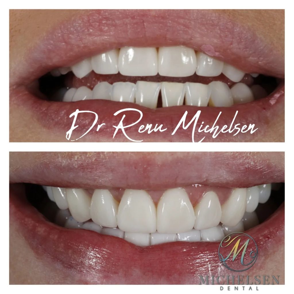 Porcelain veneers for natural-looking teeth