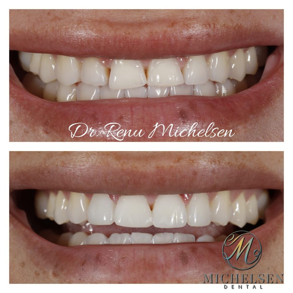 Custom porcelain veneers for a naturally enhanced smile