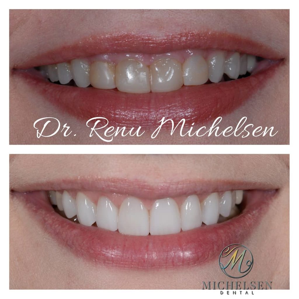 Porcelain veneers for a brighter smile