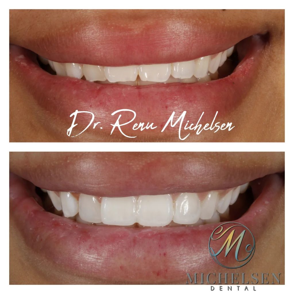 Custom veneers designed to enhance your smile
