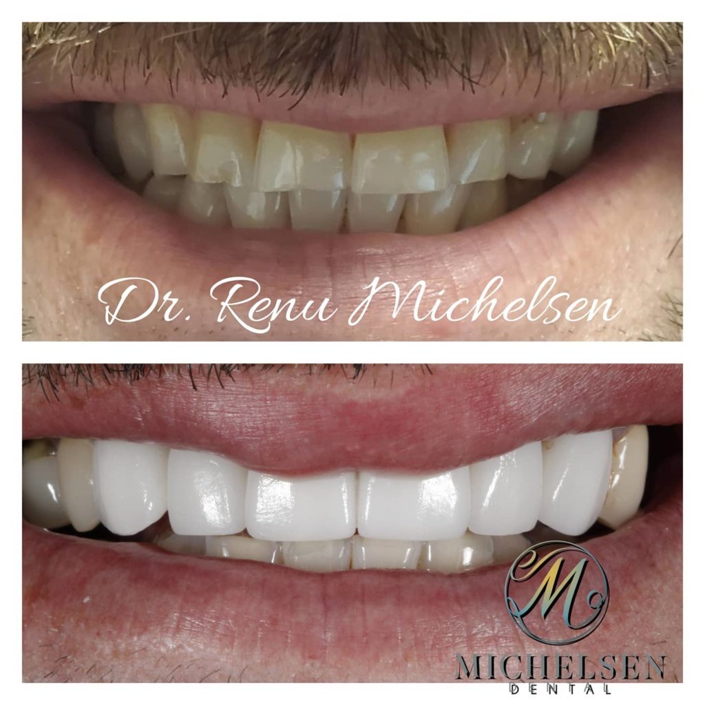 Porcelain veneers for a natural and beautiful smile