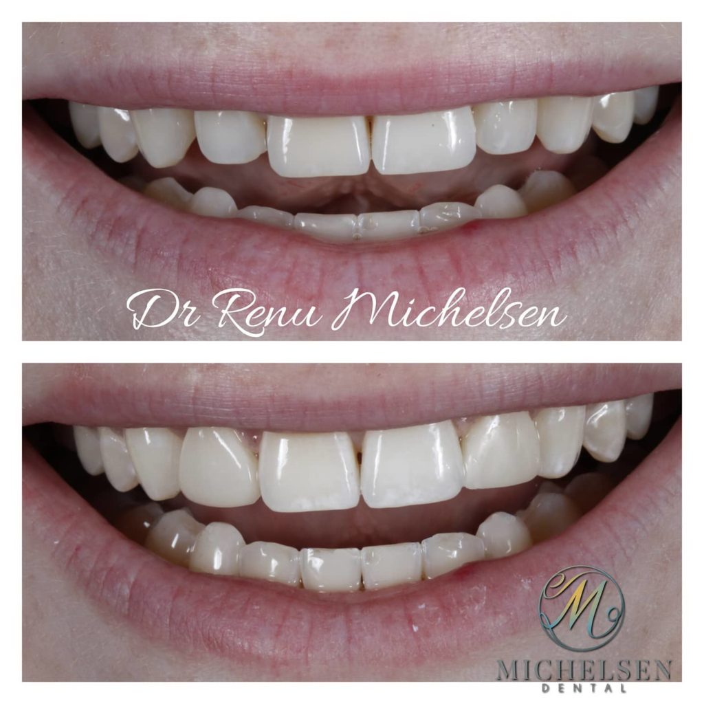Porcelain veneers designed to improve tooth appearance