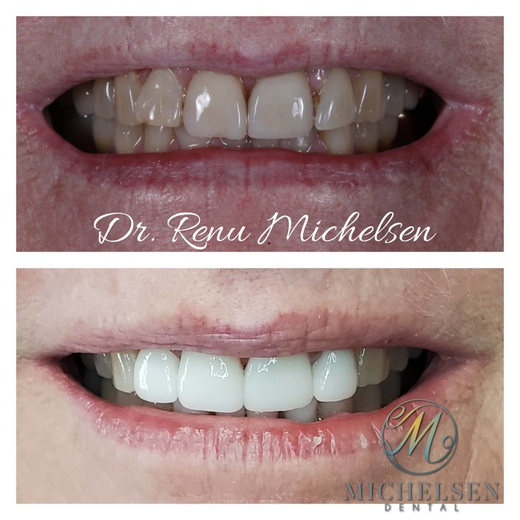 Porcelain veneers for a natural and confident smile