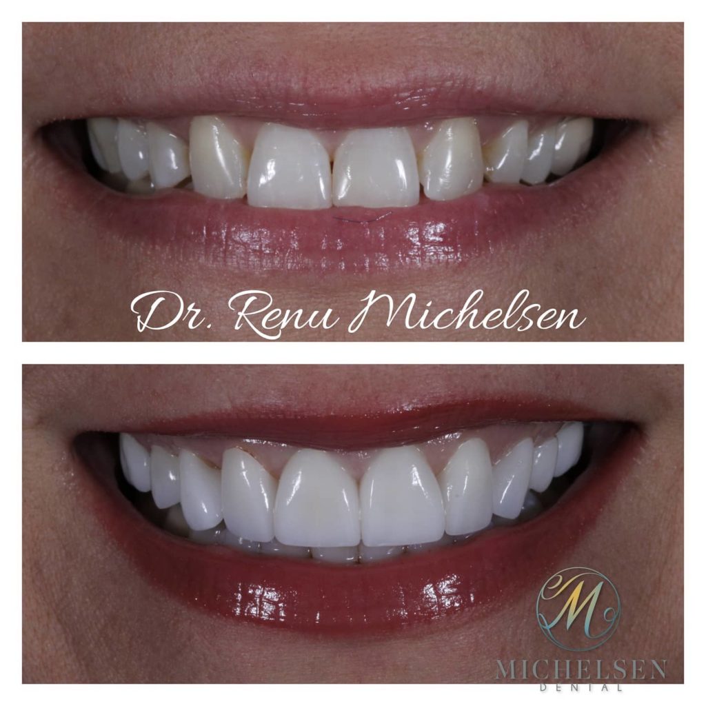 Porcelain veneer treatment for a beautiful smile