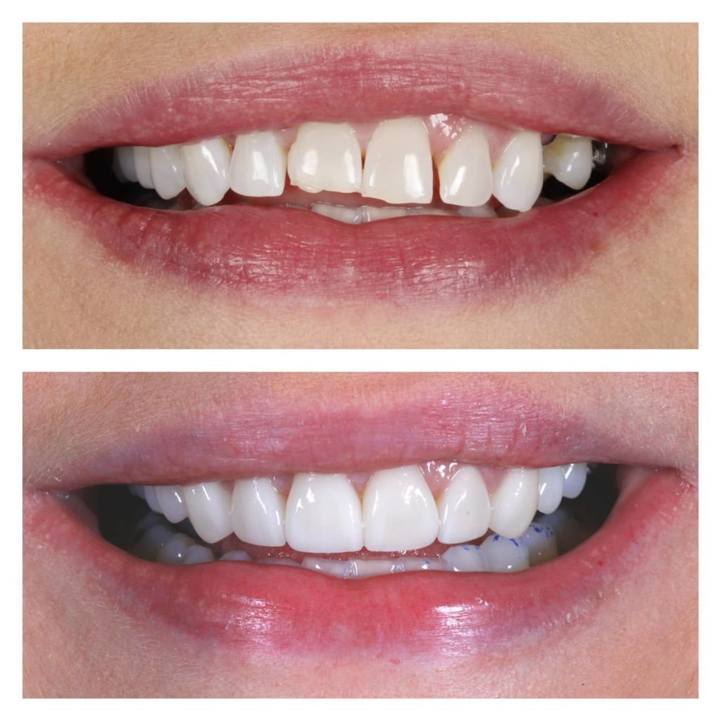 Porcelain veneers for a brighter and natural smile