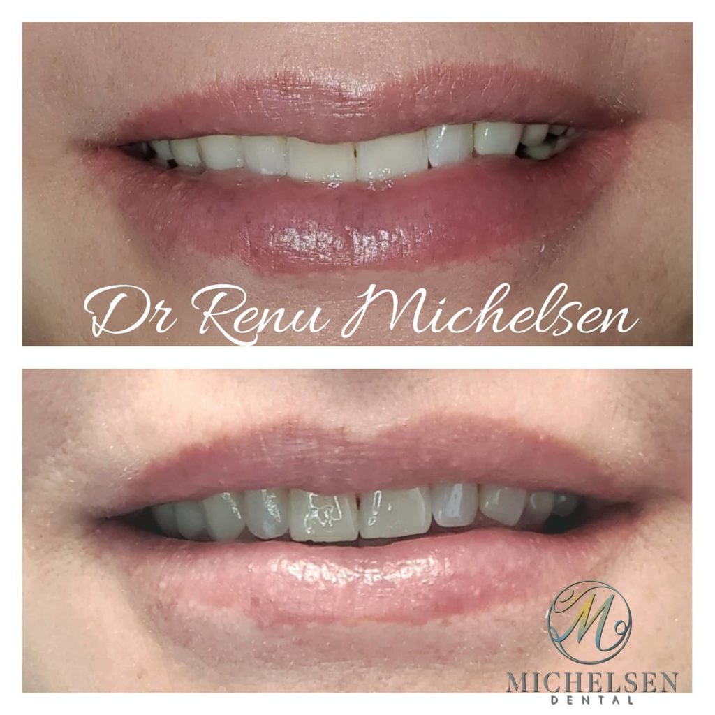 Professional cosmetic teeth whitening treatment