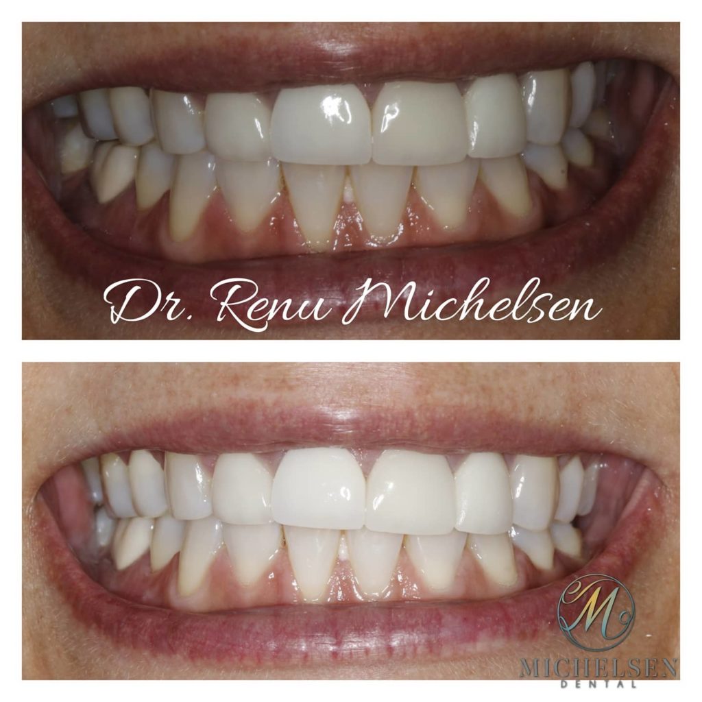 Teeth whitening procedure for a radiant smile