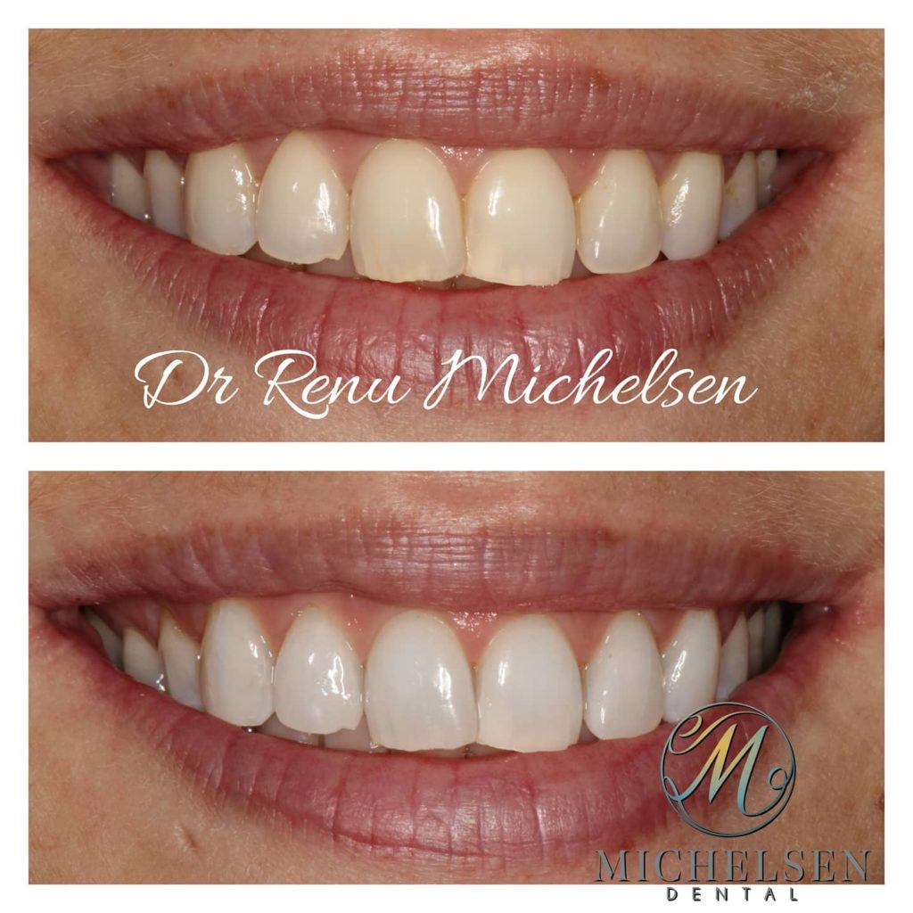 Teeth whitening treatment for a radiant smile