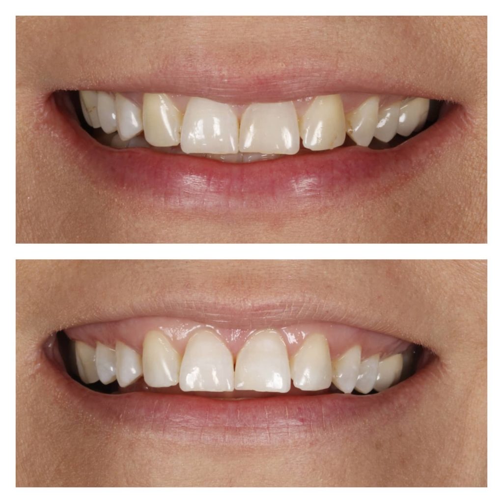 Professional teeth whitening for a brighter smile
