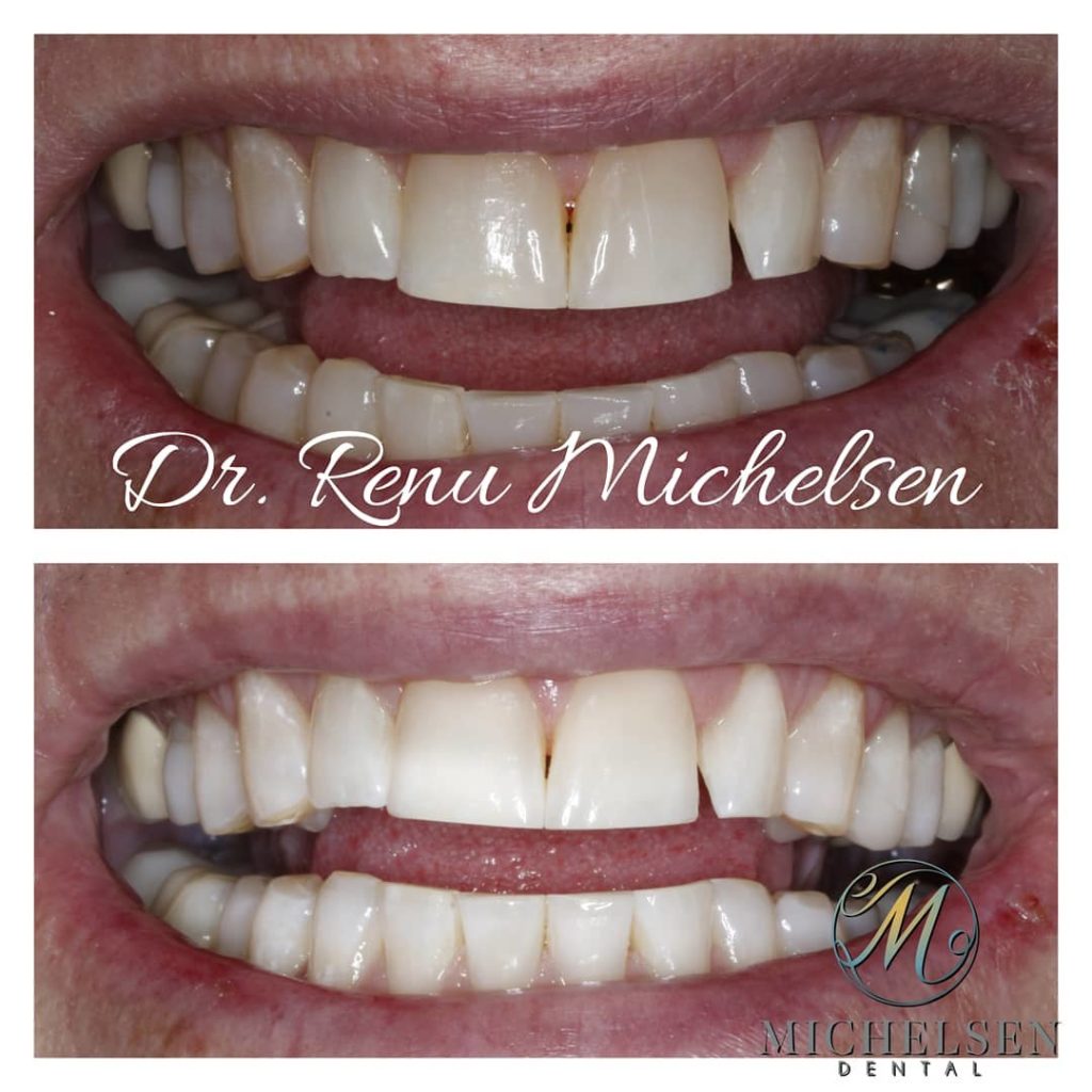 Teeth whitening treatment for a brighter, cleaner smile