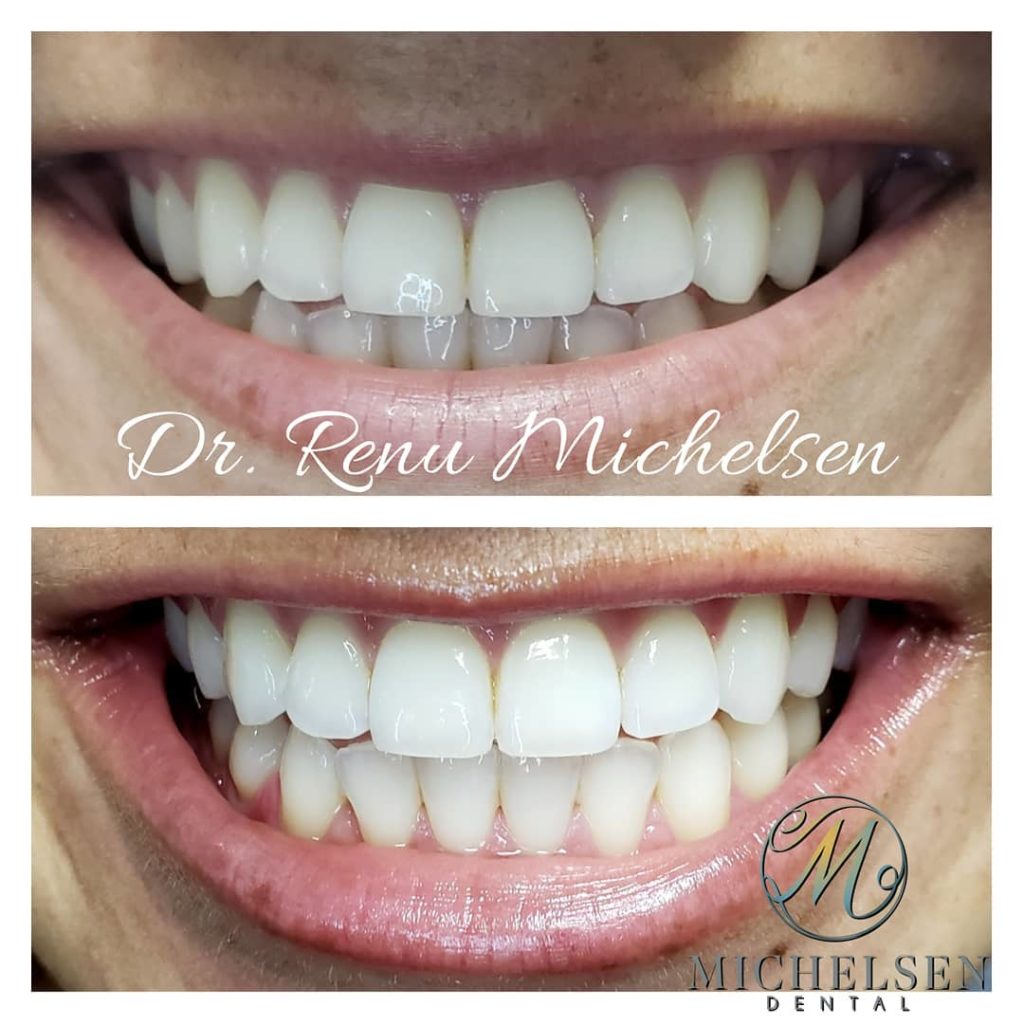 Advanced teeth whitening treatment for brighter teeth