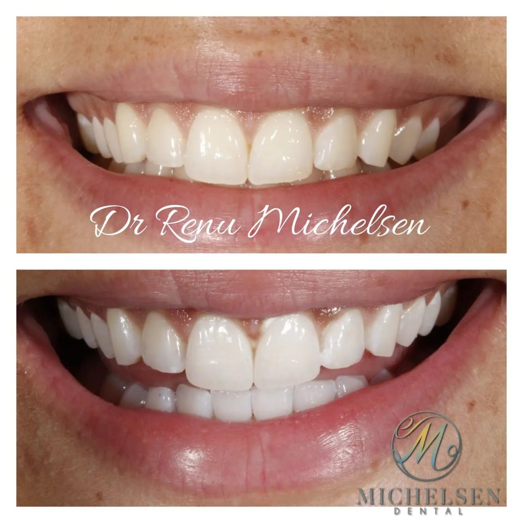 Porcelain veneers treatment for a beautiful smile