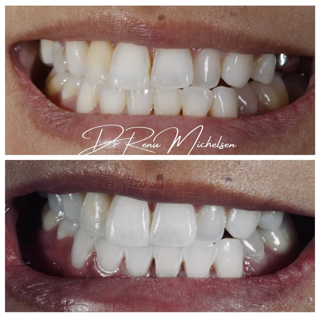 Professional teeth whitening for a brighter smile