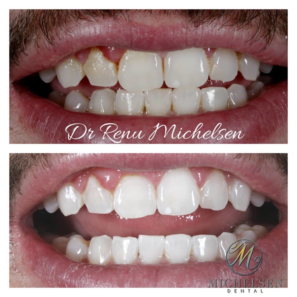 Teeth whitening treatment for a brighter appearance