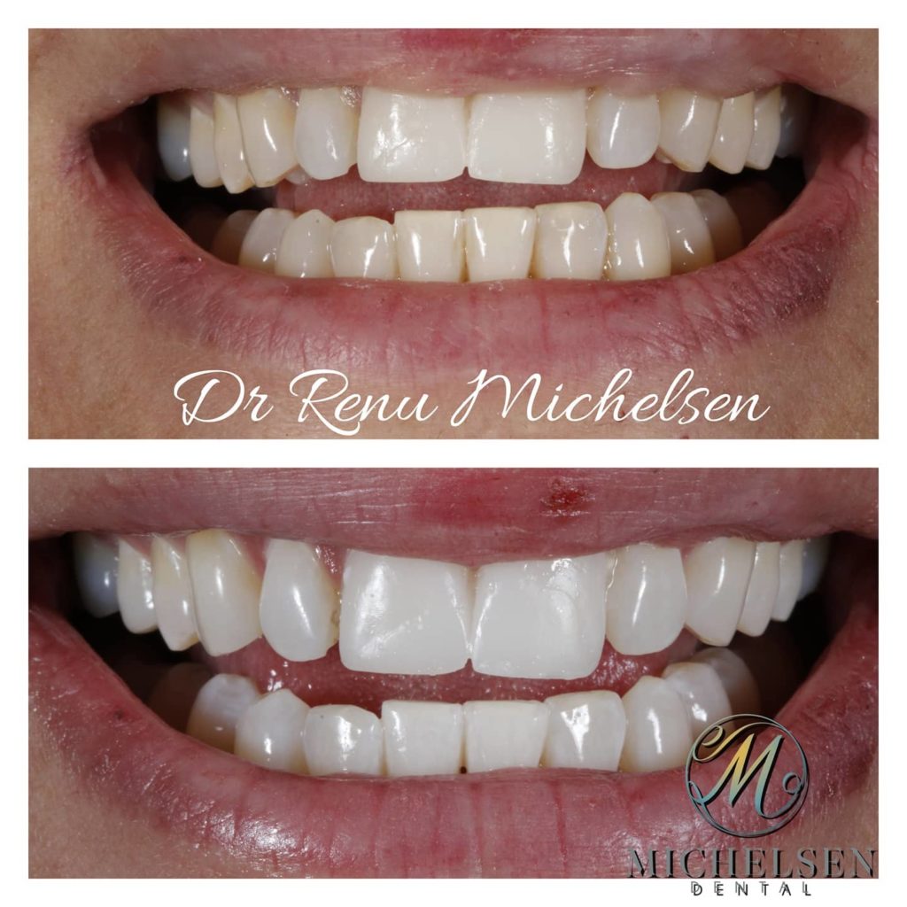 Cosmetic teeth whitening treatment