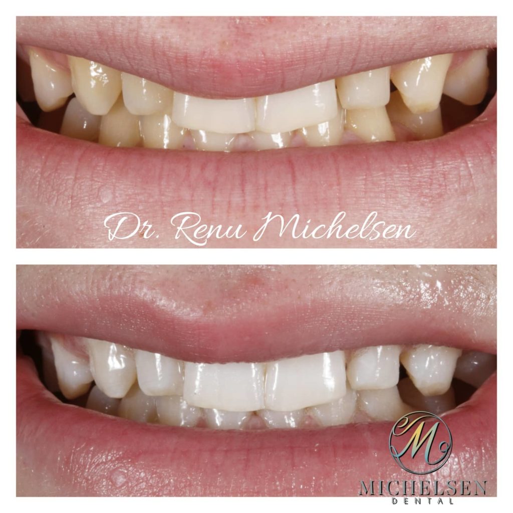 Professional teeth whitening treatment for a brighter smile