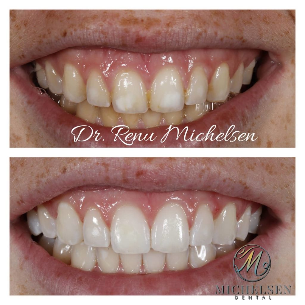 Professional teeth whitening treatment
